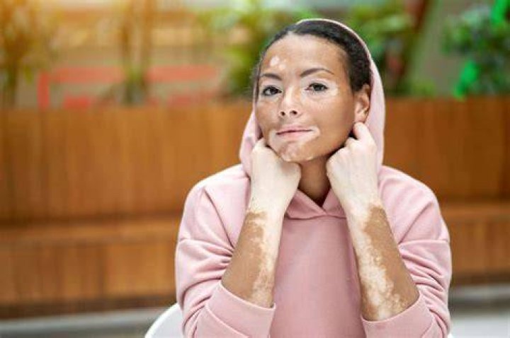 Maladie De Peau Vitiligo